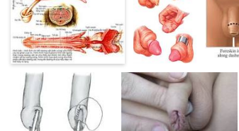 Cắt bao quy đầu là như thế nào? hẹp bao quy đầu