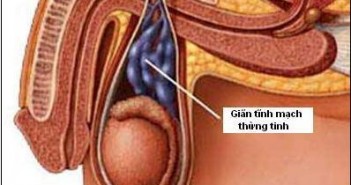 Điều trị giãn tĩnh mạch thừng tinh gian tinh mach thung tinh
