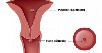 Bệnh polyp cổ tử cung chữa ở đâu polyp-co-tu-cung-chua-o-dau